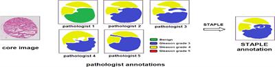 Automatic Prostate Gleason Grading Using Pyramid Semantic Parsing Network in Digital Histopathology